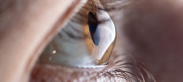 Keratoconus