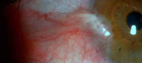 pterygium surgery