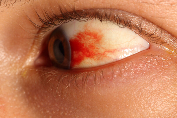 subconjunctival hemorrhage