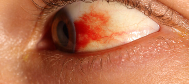 subconjunctival hemorrhage